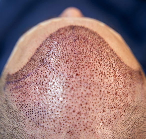 2-direct hair transplant.png